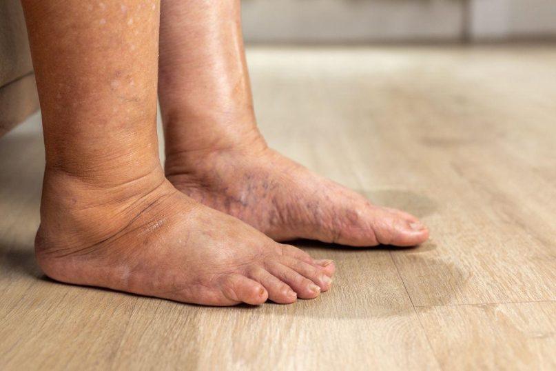 Apie kokias ligas gali įspėti edema?