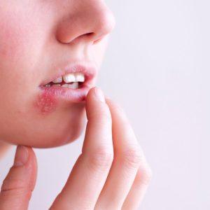 Ką daryti, jei užklupo pūslelinė? Keletas patarimų, kurie jums padės