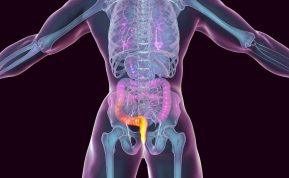 Kada yra reikalinga hemorojaus operacija? Atsako ekspertai