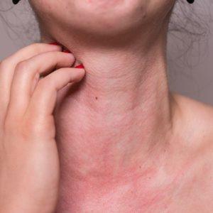 Kaip atskirti alergiją šalčiui nuo nušalimo: gydytojos atsakymas