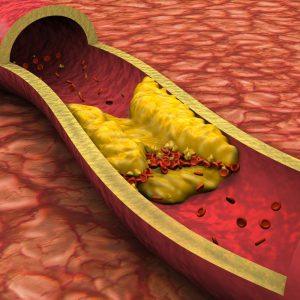 Kaip greitai galima normalizuoti cholesterolio kiekį kraujyje?
