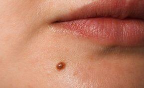 Kaip nuspėti žmogaus likimą pagal apgamus?