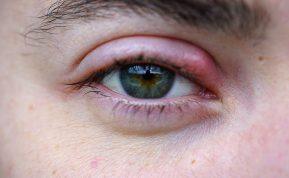 Kodėl ant akies atsiranda miežiai? Priežastis tikrai nustebins