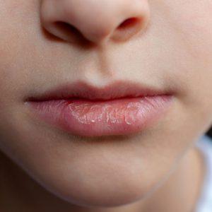 Kodėl žiemą jūsų lūpos nuolat sausėja ir kaip tai sustabdyti