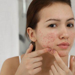 Nepadės net fotošopas: 8 spuogų atsiradimo priežastys, gadinančios jūsų gyvenimą