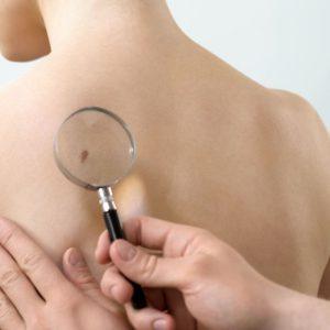 Onkologas pasakoja apie metodą, leidžiantį aptikti nematomus odos darinius