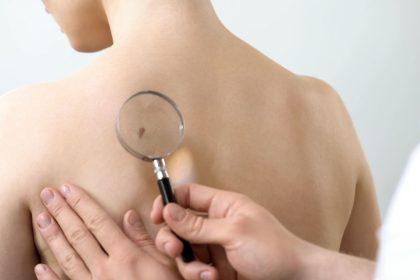 Onkologas pasakoja apie metodą, leidžiantį aptikti nematomus odos darinius