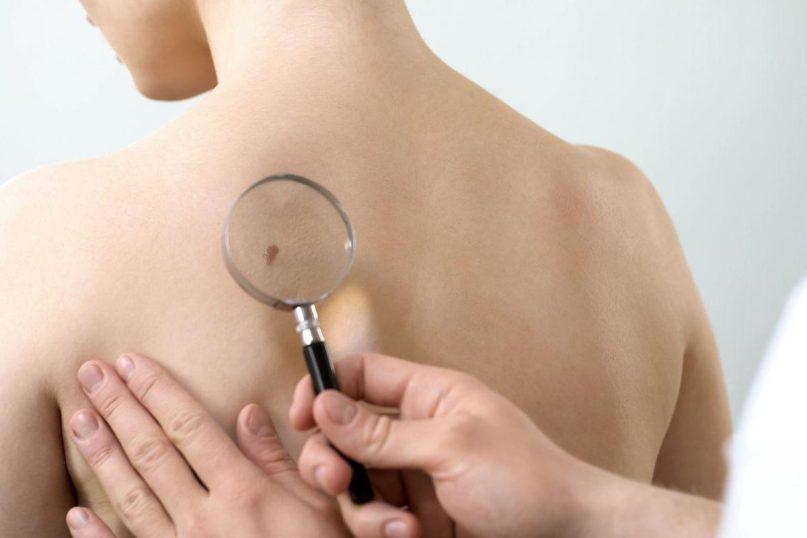 Onkologas pasakoja apie metodą, leidžiantį aptikti nematomus odos darinius