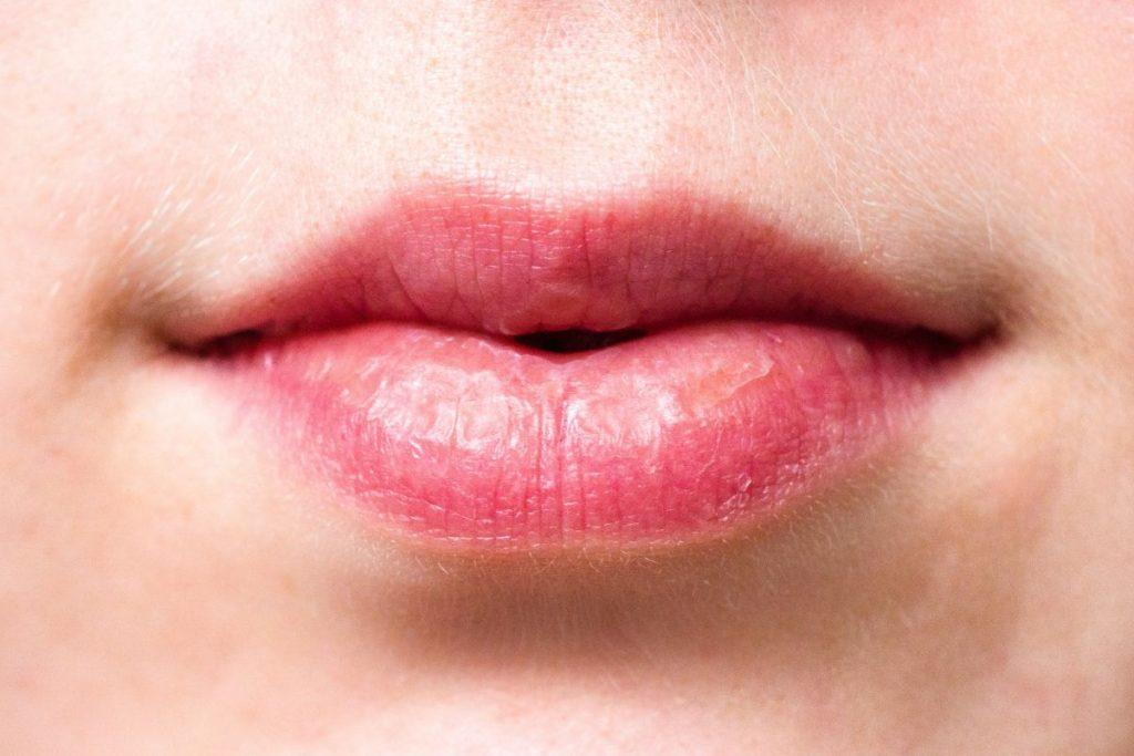 Vėjas ir sausas oras – tikri lūpų priešai