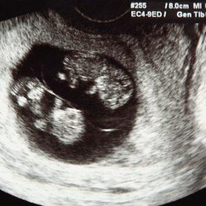 Seniausia mama pasaulyje: 74 metų moteris pagimdė dvynukes