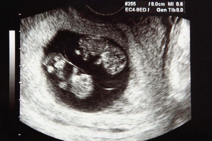 Seniausia mama pasaulyje: 74 metų moteris pagimdė dvynukes