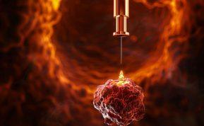 Kodėl Izraelio mokslininkai iš tiesų priartėjo prie vėžio sunaikinimo be chemoterapijos šalutinio poveikio