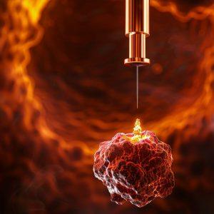 Kodėl Izraelio mokslininkai iš tiesų priartėjo prie vėžio sunaikinimo be chemoterapijos šalutinio poveikio