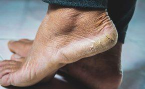 Sutrukinėjęs pėdos kulnas