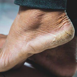 Sutrukinėjęs pėdos kulnas