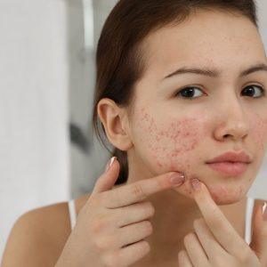 6 hormoninio disbalanso simptomai, kuriuos turėtų žinoti kiekviena moteris!