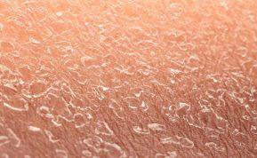 Gydytojai įspėja apie ligas, kurios pirmiausia praneša apie save išsausėjusia oda