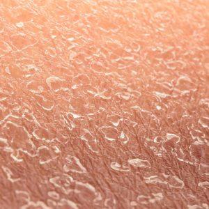 Gydytojai įspėja apie ligas, kurios pirmiausia praneša apie save išsausėjusia oda