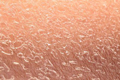 Gydytojai įspėja apie ligas, kurios pirmiausia praneša apie save išsausėjusia oda