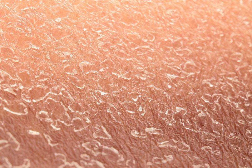 Gydytojai įspėja apie ligas, kurios pirmiausia praneša apie save išsausėjusia oda