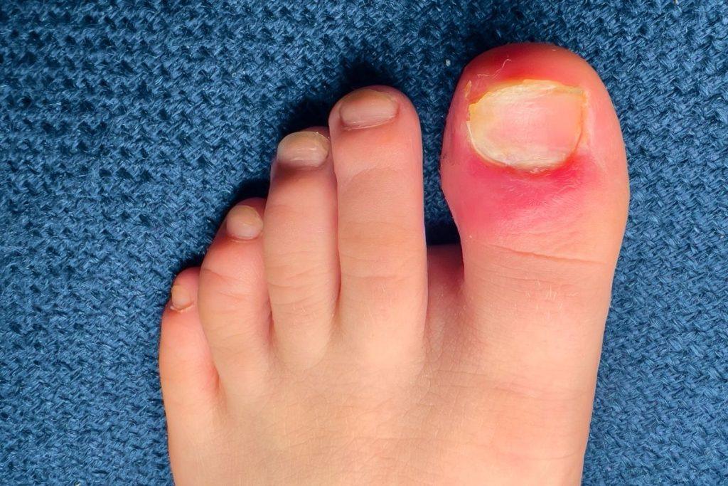 Įaugę nagai yra rimta problema. Šie patarimai padės ją išspręsti namuose. Kaip atpažinti, jog nagas įaugo