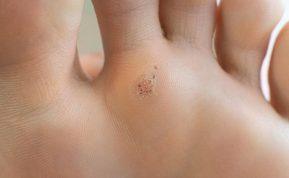 Karpos ant pėdos: kaip atsikratyti