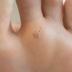 Karpos ant pėdos: kaip atsikratyti