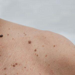 Kodėl senstant ant odos atsiranda pigmentinės dėmės: ar verta jas šalinti?