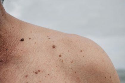 Kodėl senstant ant odos atsiranda pigmentinės dėmės: ar verta jas šalinti?