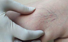 Močiutės būdas atsikratyti venų varikozės. Rezultatas - per savaitę