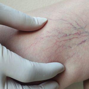 Močiutės būdas atsikratyti venų varikozės. Rezultatas - per savaitę