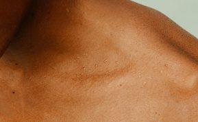 Nekartokite šios klaidos ir jūsų odą nustos niežėti kiekvieną žiemą