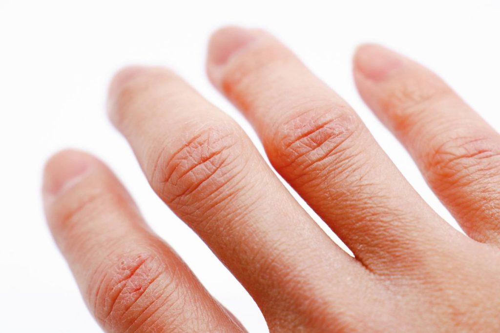 Nekartokite šios klaidos ir jūsų odą nustos niežėti kiekvieną žiemą. Kodėl oda praranda drėgmė dvigubai greičiau