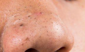 Ši kaukė naikina juoduosius taškelius! Pigus ir efektyvus būdas