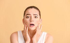 Specialistas atsakė, kas lemia spuogų atsiradimą ir kaip jų išvengti