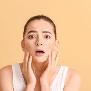 Specialistas atsakė, kas lemia spuogų atsiradimą ir kaip jų išvengti