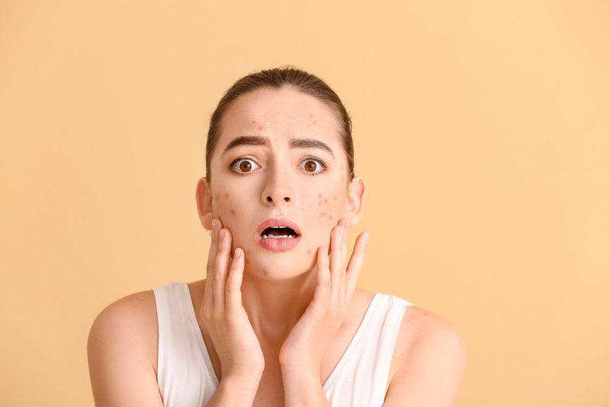 Specialistas atsakė, kas lemia spuogų atsiradimą ir kaip jų išvengti