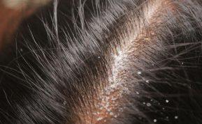 Tik du šaukštai šių sėklų išgelbės jus nuo pleiskanų. Kaukė atgaivinsianti jūsų plaukus