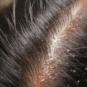 Tik du šaukštai šių sėklų išgelbės jus nuo pleiskanų. Kaukė atgaivinsianti jūsų plaukus