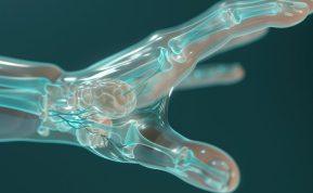 Higroma ant rankų: kodėl atsiranda ir kaip atpažinti šią cistą