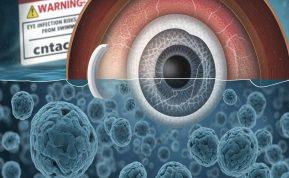 Akantaminis keratitas: kodėl kontaktinių lęšių naudotojai rizikuoja savo regėjimu